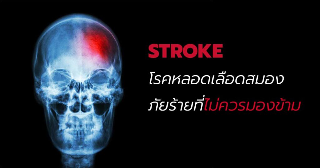 ผู้ป่วย stroke